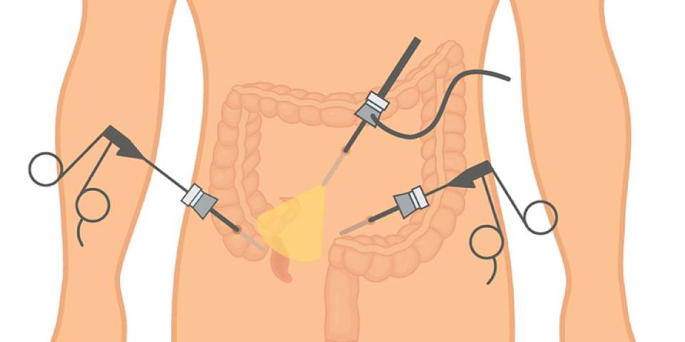 appendix surgery in chennai