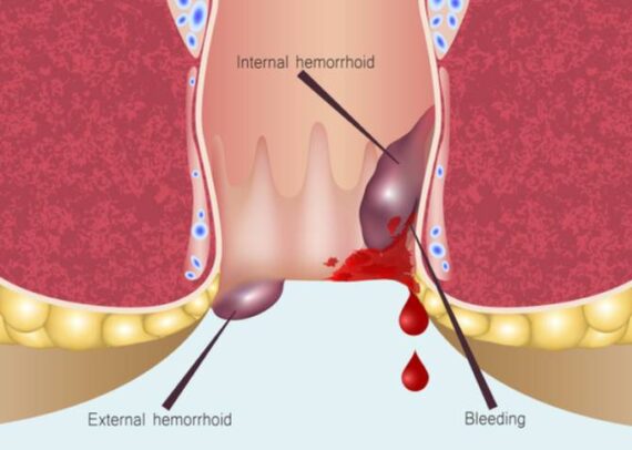 Anorectal Bleeding? Do Not Ignore Anorectal Bleeding - Dr. Pinak Dasgupta