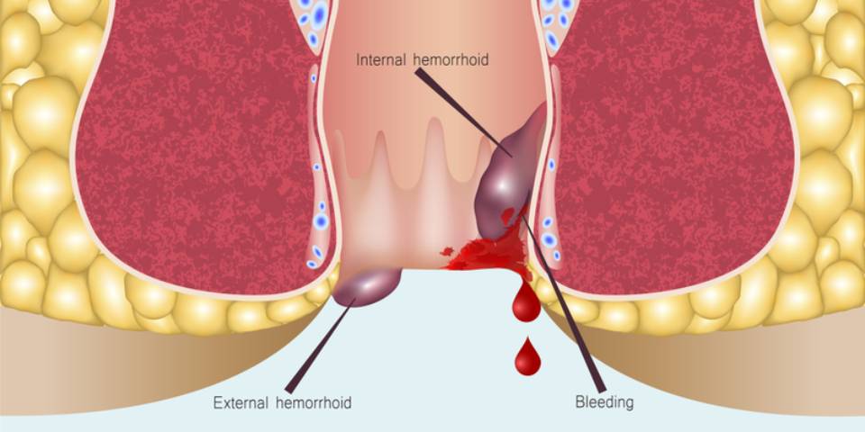 Anorectal Bleeding? Do Not Ignore Anorectal Bleeding - Dr. Pinak Dasgupta