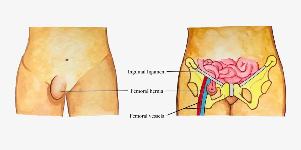 Medical illustration showing femoral hernia location near the groin with labelled anatomy.