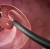 Colonoscopy screening for colon polyps by Dr. Pinak Dasgupta at GEM Hospital Chennai