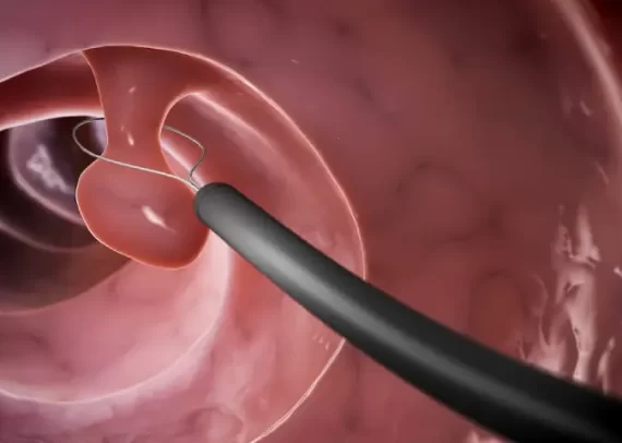 Colonoscopy screening for colon polyps by Dr. Pinak Dasgupta at GEM Hospital Chennai