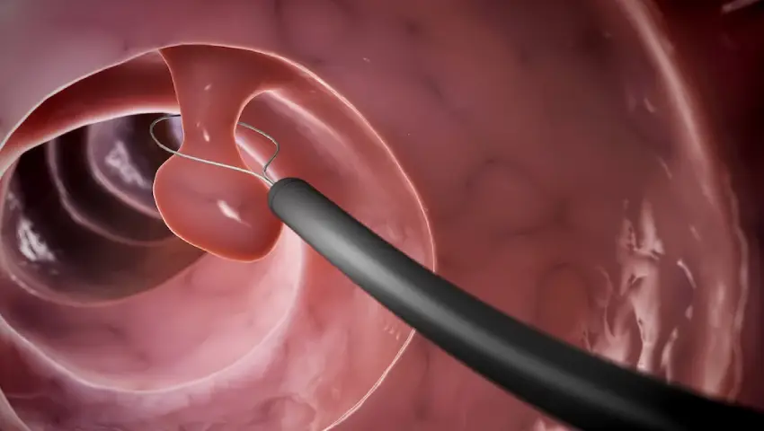 Colonoscopy screening for colon polyps by Dr. Pinak Dasgupta at GEM Hospital Chennai