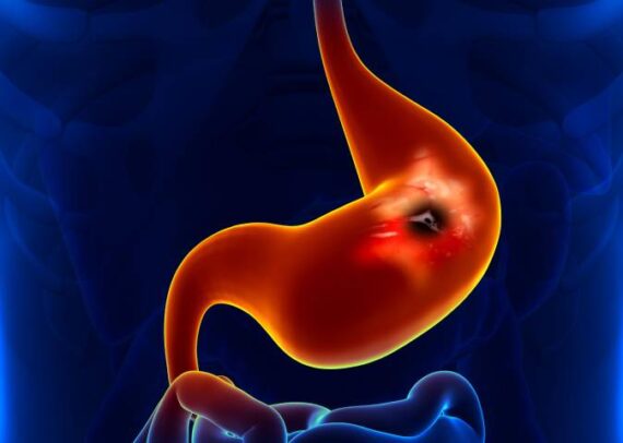 Robotic and laparoscopic surgery for peptic ulcer treatment by Dr. Pinak Dasgupta at GEM Hospital Chennai