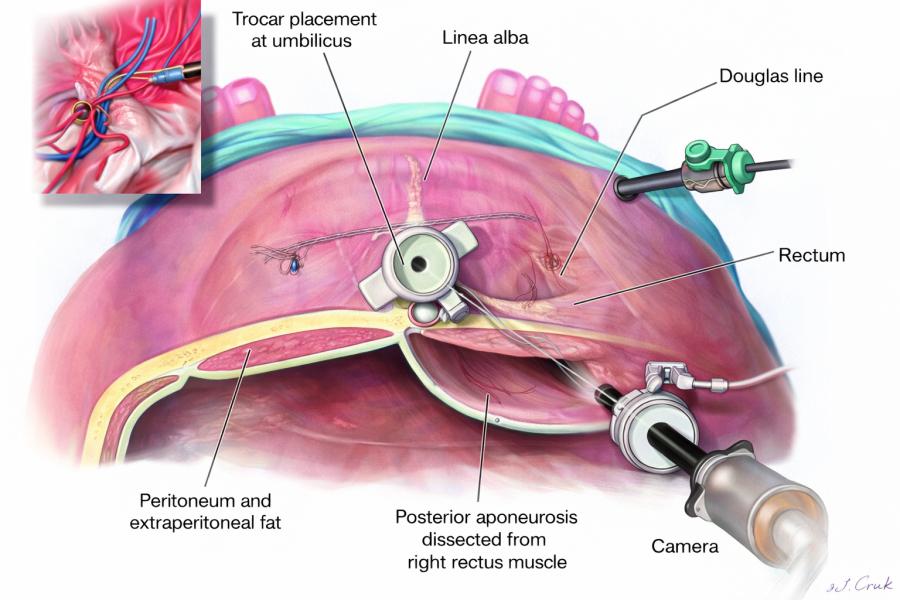 Top Minimally Invasive Hernia Repair Techniques In India TAPP TEP Top Minimally Invasive Hernia Repair Techniques In India TAPP TEP